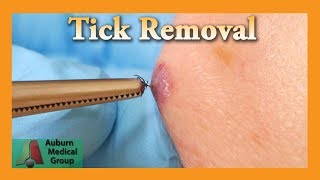 Dead Tick Removal  Auburn Medical Group [upl. by Nylqcaj999]