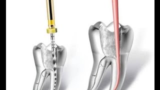 Endodontie  les étapes du traitement endodontique en détail [upl. by Benilda]