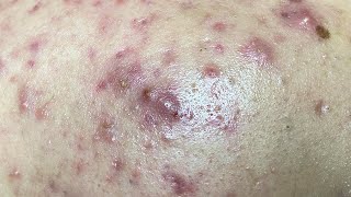 AWESOME HIDDEN ACNE and BLACKHEADS REMOVAL 460 [upl. by Letnohs]