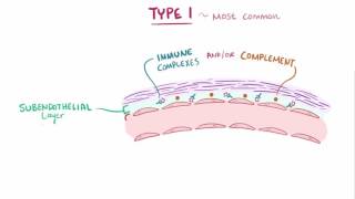 Nephrotic Syndrome  Pathology mini tutorial [upl. by Aneerb]