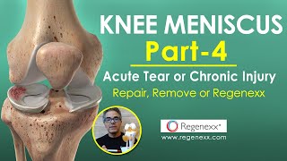 meniscus tear rehabilitation exercise 3 knee stability [upl. by Audrit]