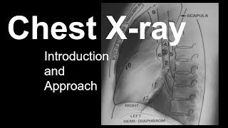 How XRays Work  How to Read a Chest XRay Part 3  MEDZCOOL [upl. by Anerehs]