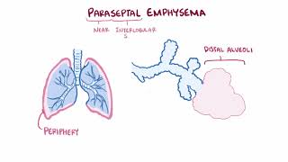 Emphysema chronic obstructive pulmonary disease centriacinar panacinar paraseptal [upl. by Airamas]