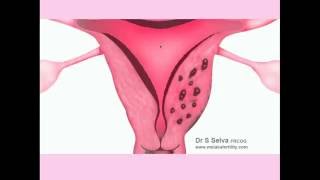 Adenomyosis  CRASH Medical Review Series [upl. by Onitnerolf]