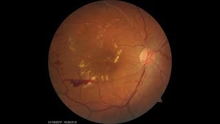 Treatment for Retinal Vein Occlusion [upl. by Enyaz]