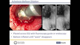 Pneumatic balloon dilation in achalasia [upl. by Namzaj]