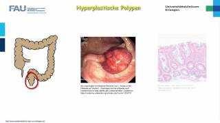 Pathologie ─ Darmerkrankungen [upl. by Oran]