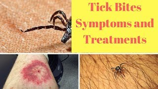 Tick Bites Symptoms and Treatments [upl. by Eisinger]