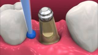 Smyl Manatee  Dental Implant Procedure [upl. by Lizzie]