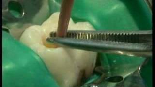 Endodontie mécanisée le système PROTAPER® principes et guide dutilisation [upl. by Daisi]