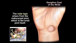 Ganglion Cyst of the Foot [upl. by Gytle]