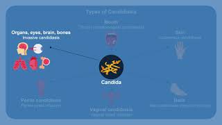 Overcoming Challenges in the Diagnosis and Treatment of Invasive Fungal Infections [upl. by Chris]