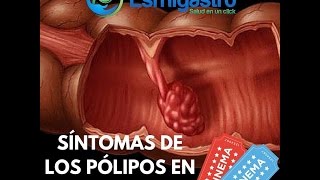 Síntomas de Pólipos en el Colon [upl. by Roshan]