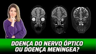 NERVOS ÓPTICOS MUITO ALÉM DA NEURITE ÓPTICA [upl. by Atteuqahs789]