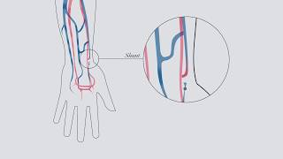 Understanding hemodialysis [upl. by Nehgaem17]