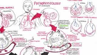 Emphysema  Pathophysiology COPD [upl. by Capone]