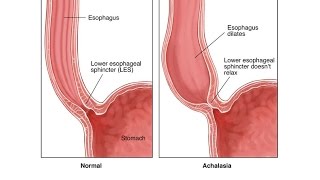 Achalasia [upl. by Mosera]