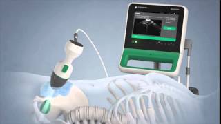 Verathon BladderScan Prime Portable Ultrasound Instrument [upl. by Nelon]