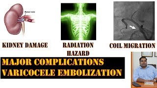 Complications of Varicocele Embolization  Microsurgery vs Embolization for Varicocele [upl. by Rheingold619]