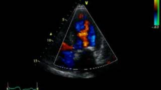 HOCM  AORTIC STENOSIS  LVOT FLOW [upl. by Thayne462]