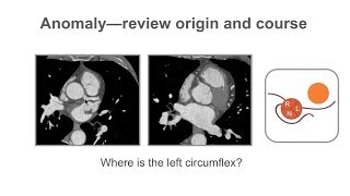 Describing coronary artery anomalies [upl. by Etz492]