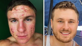 How I FINALLY Got Rid of My Acne [upl. by Eikcim536]