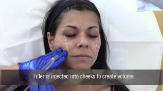 Injecting fillers in cheeks at Advanced Dermatology [upl. by Eiznikcm]