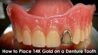 How to Place 14K Gold on a Denture Tooth [upl. by Akram]