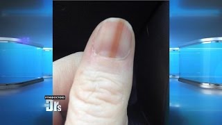 Melanoma on Your Nail [upl. by Nwahsyd922]