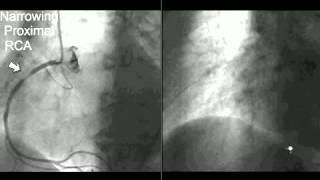 Cerebral Angiography Procedure [upl. by Amanda822]