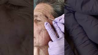 Acne extraction of blackheads and whiteheads popping pimples in Los Angeles [upl. by Ano]