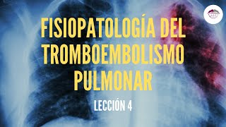 4 FISIOPATOLOGÍA DEL TROMBOEMBOLISMO PULMONAR FISIOPATOLOGÍA RESPIRATORIA [upl. by Nostets]