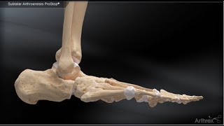 Subtalar Arthroereisis ProStop® [upl. by Ezarras695]