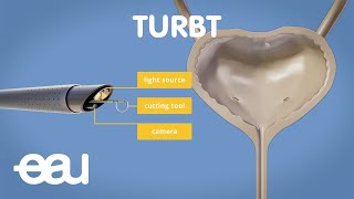 Bladder cancer treatment TURBT [upl. by Atir971]