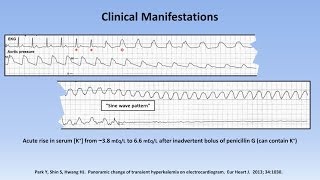 Hyperkalemia [upl. by Hameean636]