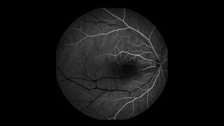 Pulsating Cilioretinal Artery From Elevated Eye Pressures [upl. by Herstein]