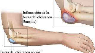 BURSITIS CODO DERRAME ARTICULAR TRATAMIENTO [upl. by Rouvin]