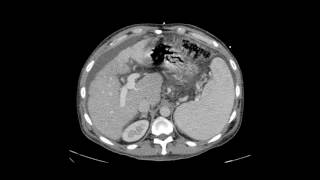 Transjugular Intrahepatic Portosystemic Shunt TIPS [upl. by Divan439]