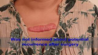 Chest Keloids  Mistakes to Avoid [upl. by Yrek]