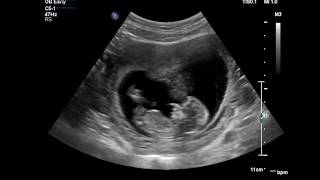 Advanced Early Pregnancy Scan 1219 weeks [upl. by Thedrick251]