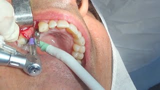 CIRURGIA DE IMPLANTE  IMPLANT SURGERY [upl. by Annaiv]