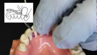 Ribbond Periodontal Splint Technique [upl. by Kaule]