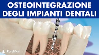 Le osteointegrazione degli impianti dentali © [upl. by Netnerb]