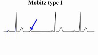 ECG Interpretation  AtrioVentricular Block [upl. by Eecart]