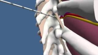 Techniques for Thoracic Paravertebral Block TPVB [upl. by Auberbach]