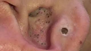 Ear Blackheads 2020 Blackhead Pops extraction point noir [upl. by Ilonka]