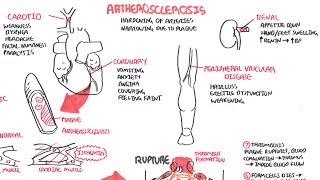 Atherosclerosis  Pathophysiology [upl. by Isidore]