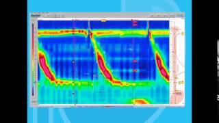 Esophageal Motility Disorders Part 1 [upl. by Yc]