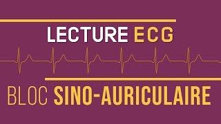 Interprétation ECG  Bloc SinoAuriculaire [upl. by Krenek]