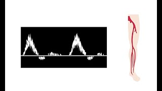 Interpreting duplex waveforms [upl. by Schlosser383]